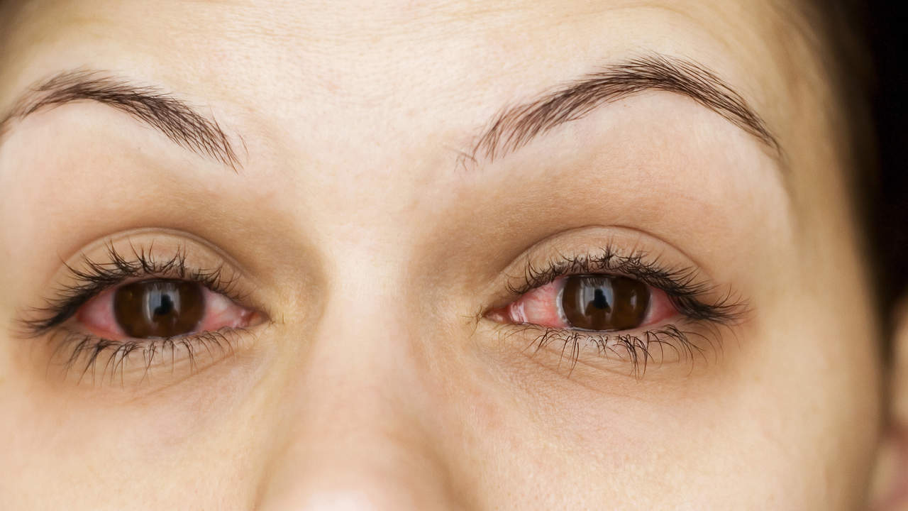 Close-Up Of Woman With Pink Whites Of Her Eyes